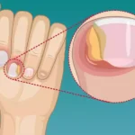 Paronychia Treatments