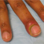 Paronychia Treatments