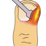 Which Paronychia Treatments Work Without Antibiotics