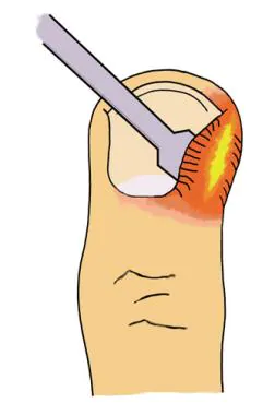 Which Paronychia Treatments Work Without Antibiotics