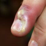 What Paronychia Treatments Do For Work-Related Irritation