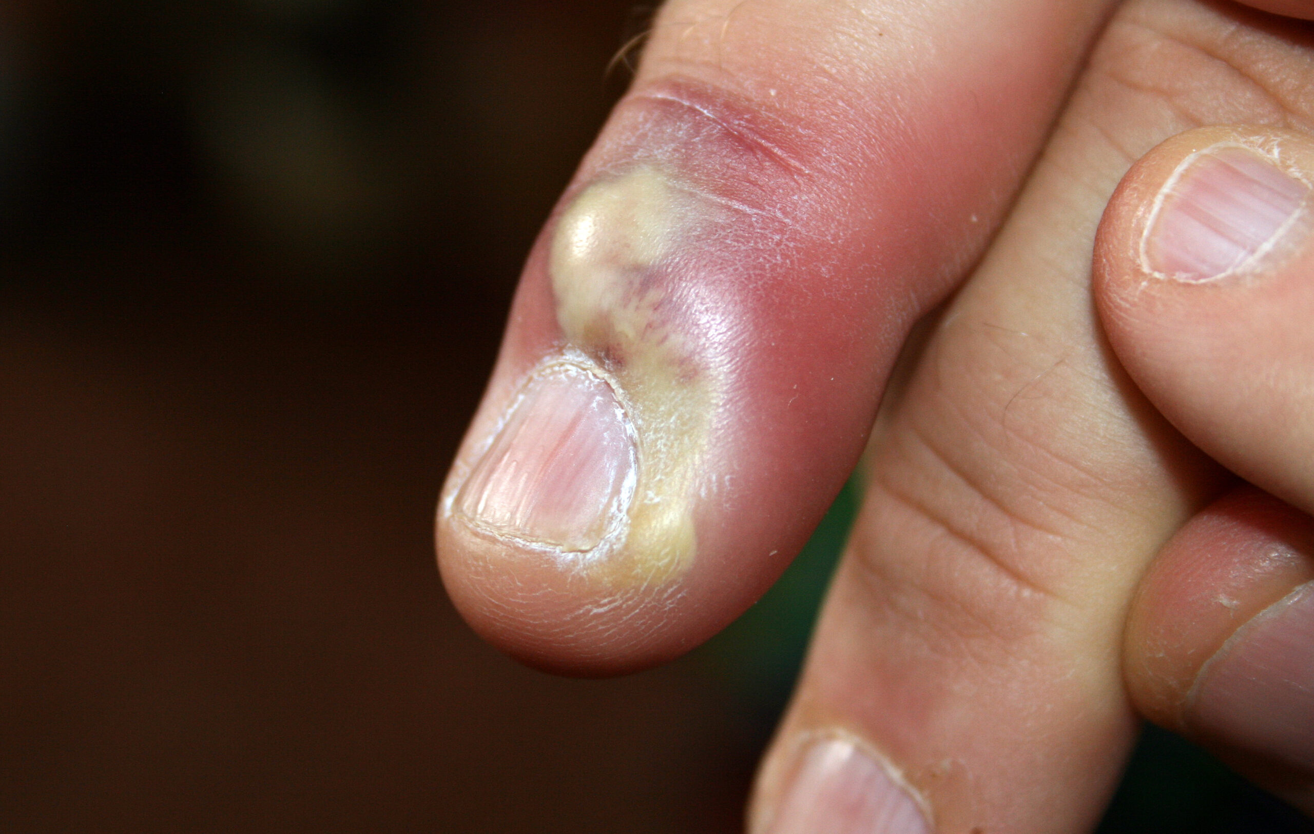 What Paronychia Treatments Do For Work-Related Irritation