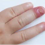 Why Paronychia Treatments Differ By Infection Type