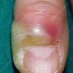 How Paronychia Treatments Ease Severe Discomfort Type / to choose a block