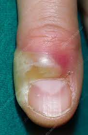 How Paronychia Treatments Ease Severe Discomfort Type / to choose a block