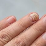 Do Paronychia Treatments Help With Swollen Cuticles