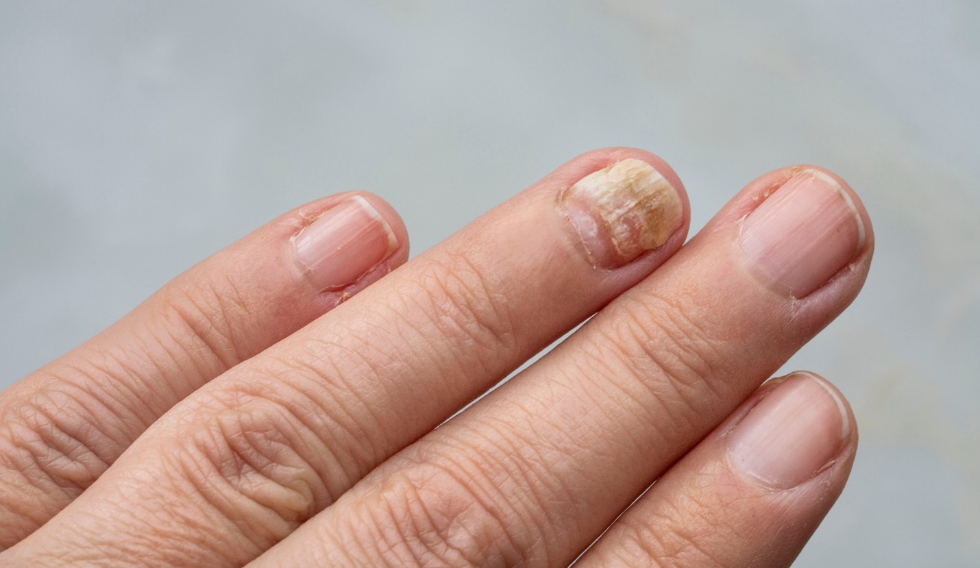 Do Paronychia Treatments Help With Swollen Cuticles