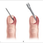 How Paronychia Treatments Reduce Nail Inflammation