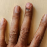 Why Paronychia Treatments Are Often Misunderstood