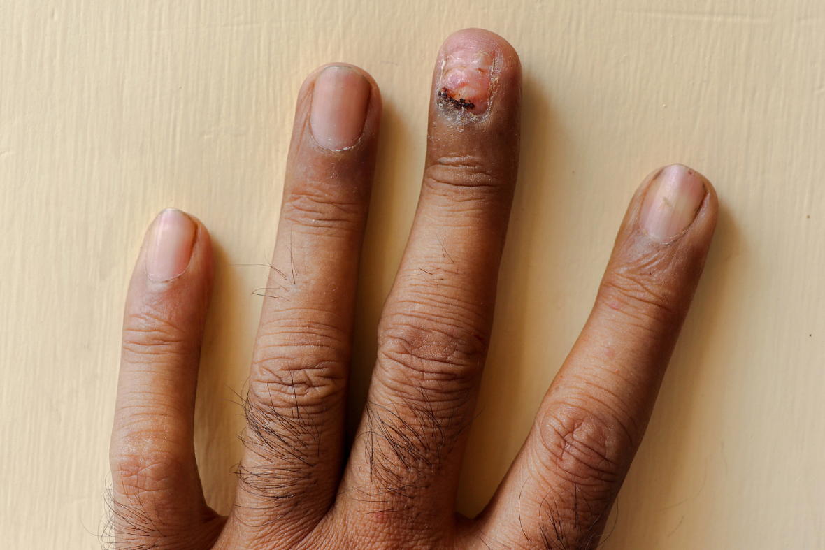 Why Paronychia Treatments Are Often Misunderstood