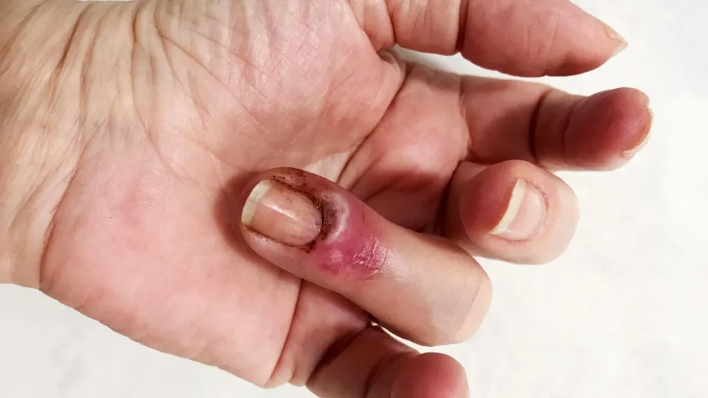 Why Paronychia Treatments Matter For Nail Biters
