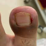 What Paronychia Treatments Offer For Diabetic Patients