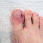 When Paronychia Treatments Require Medical Attention