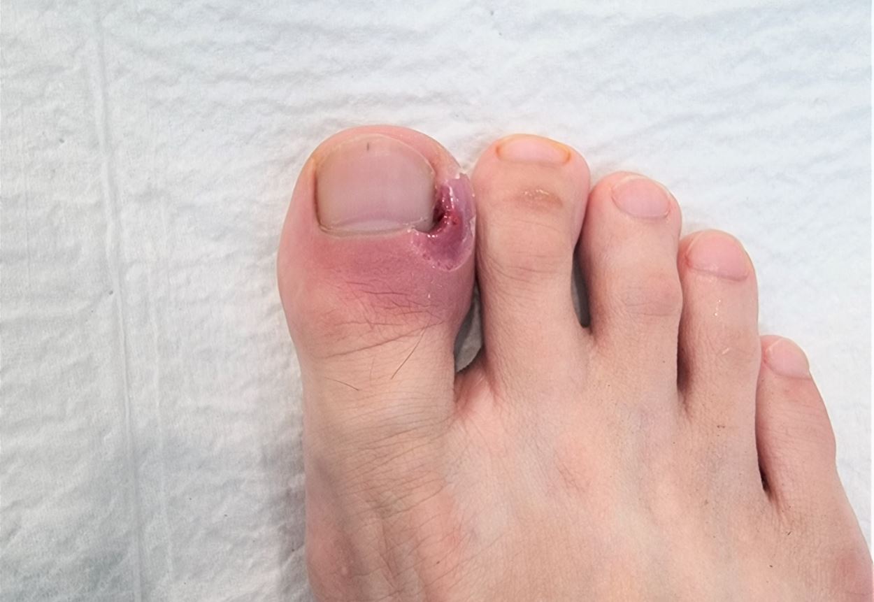 When Paronychia Treatments Require Medical Attention