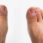 Should Paronychia Treatments Include Warm Soaks Daily